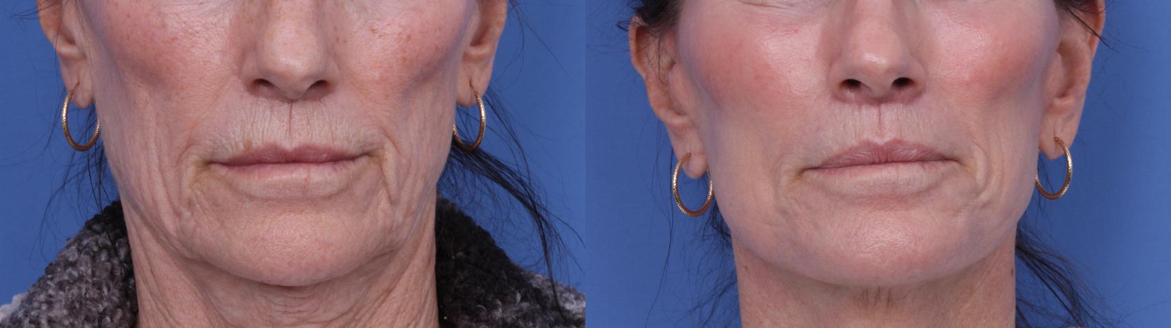 Before & After CO2 Laser Resurfacing (under anesthesia) Case 729 Zoom SNLL View in Scottsdale, AZ
