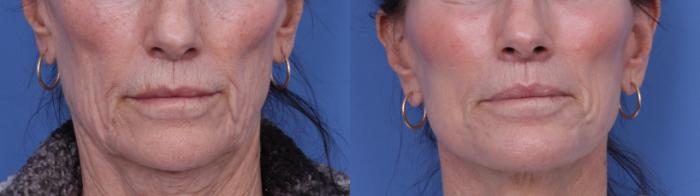 Before & After CO2 Laser Resurfacing (under anesthesia) Case 729 Zoom SNLL View in Scottsdale, AZ