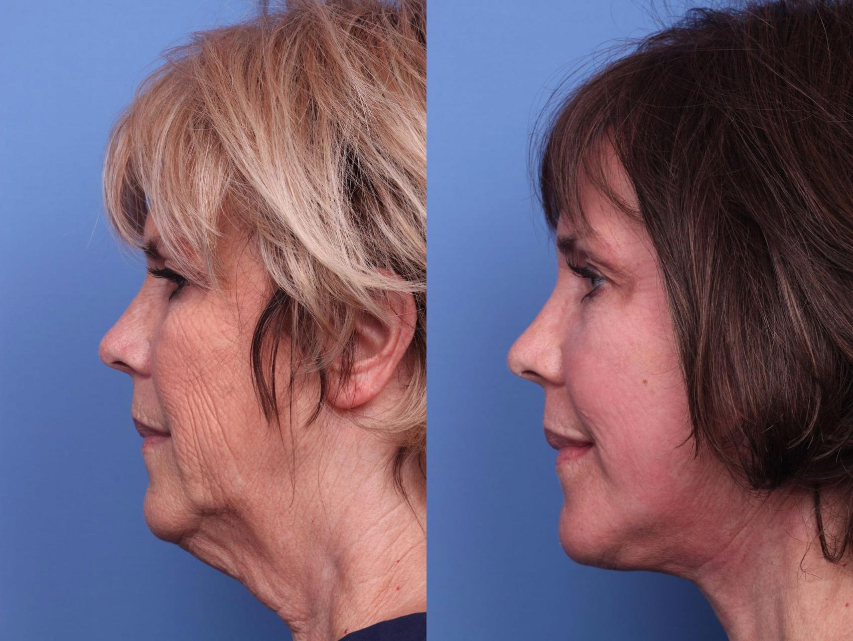 Before & After Facelift Case 73 View #2 View in Scottsdale, AZ