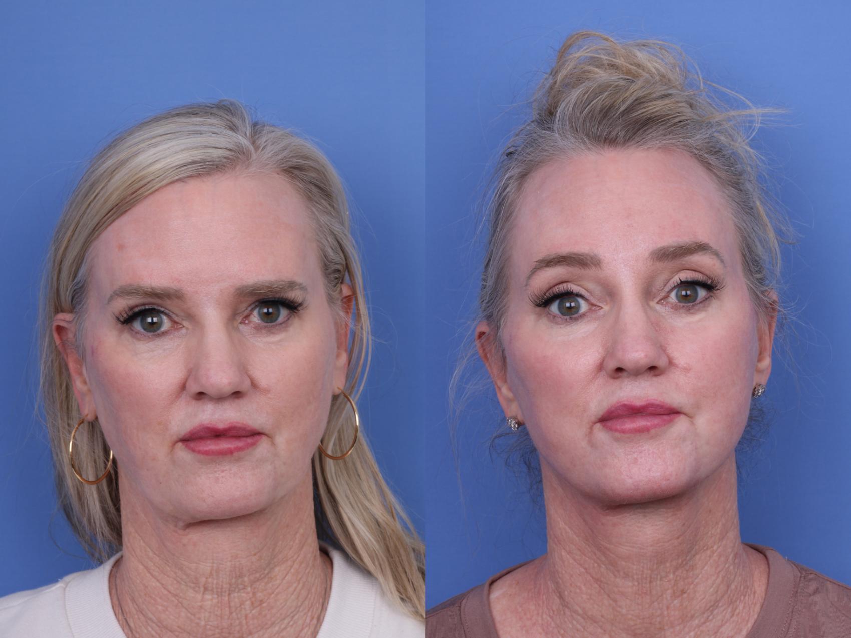 Before & After CO2 Laser Resurfacing (under anesthesia) Case 732 Front View in Scottsdale, AZ