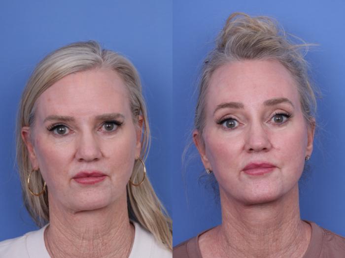 Before & After CO2 Laser Resurfacing (under anesthesia) Case 732 Front View in Scottsdale, AZ