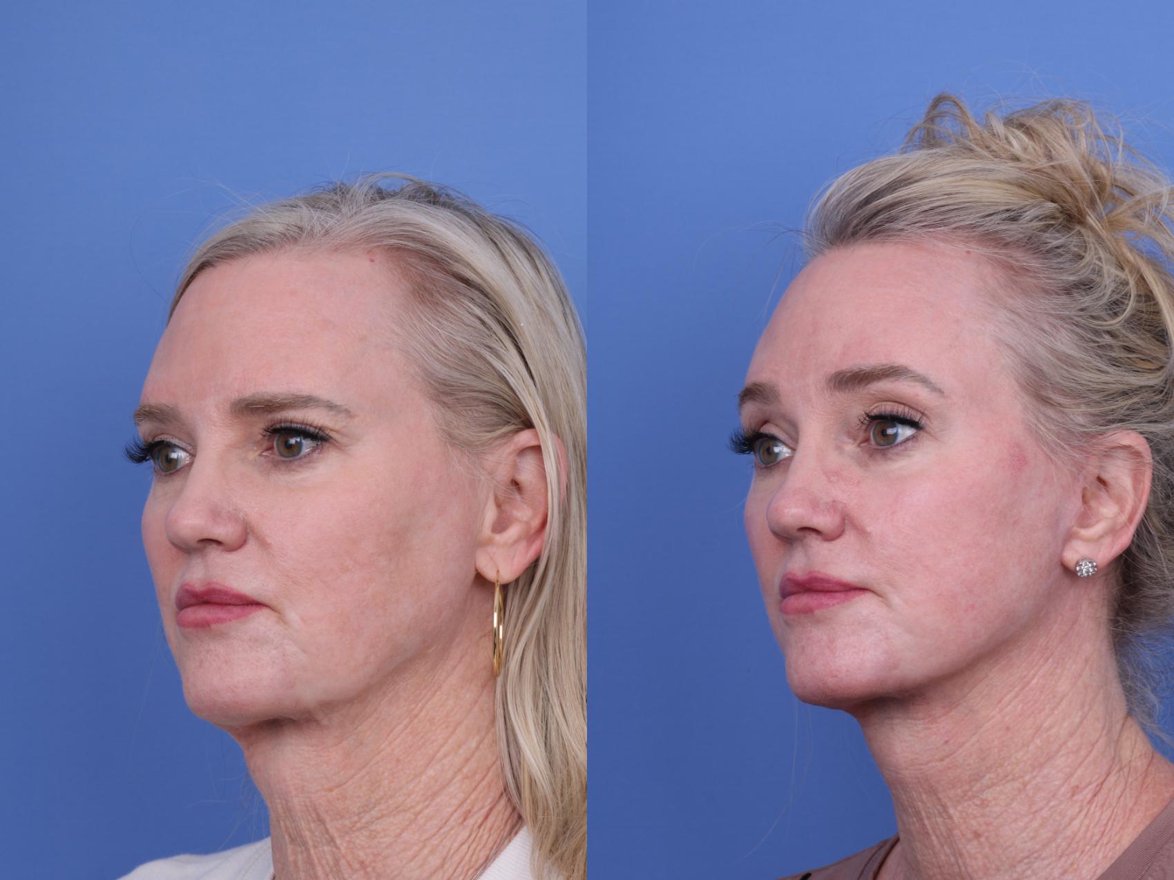 Before & After CO2 Laser Resurfacing (under anesthesia) Case 732 Left Oblique View in Scottsdale, AZ
