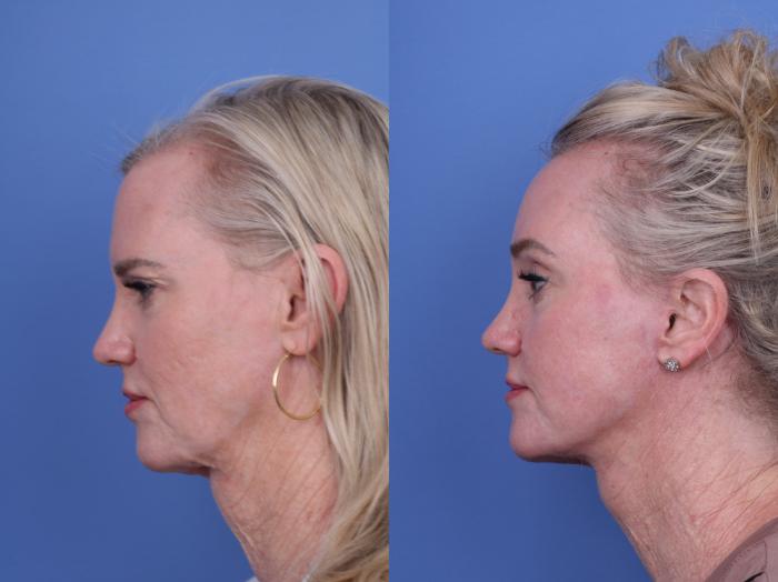 Before & After CO2 Laser Resurfacing (under anesthesia) Case 732 Left Side View in Scottsdale, AZ
