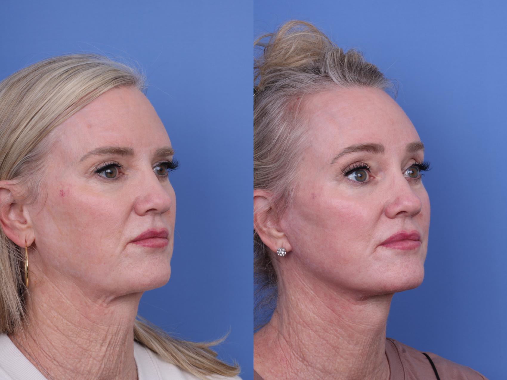Before & After CO2 Laser Resurfacing (under anesthesia) Case 732 Right Oblique View in Scottsdale, AZ