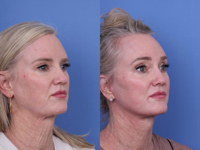 Before & After CO2 Laser Resurfacing (under anesthesia) Case 732 Right Oblique View in Scottsdale, AZ