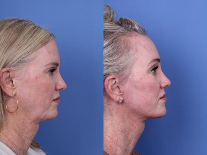 Before & After CO2 Laser Resurfacing (under anesthesia) Case 732 Right Side View in Scottsdale, AZ