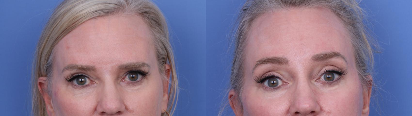 Before & After CO2 Laser Resurfacing (under anesthesia) Case 732 Zoom Endoscopic Forehead View in Scottsdale, AZ