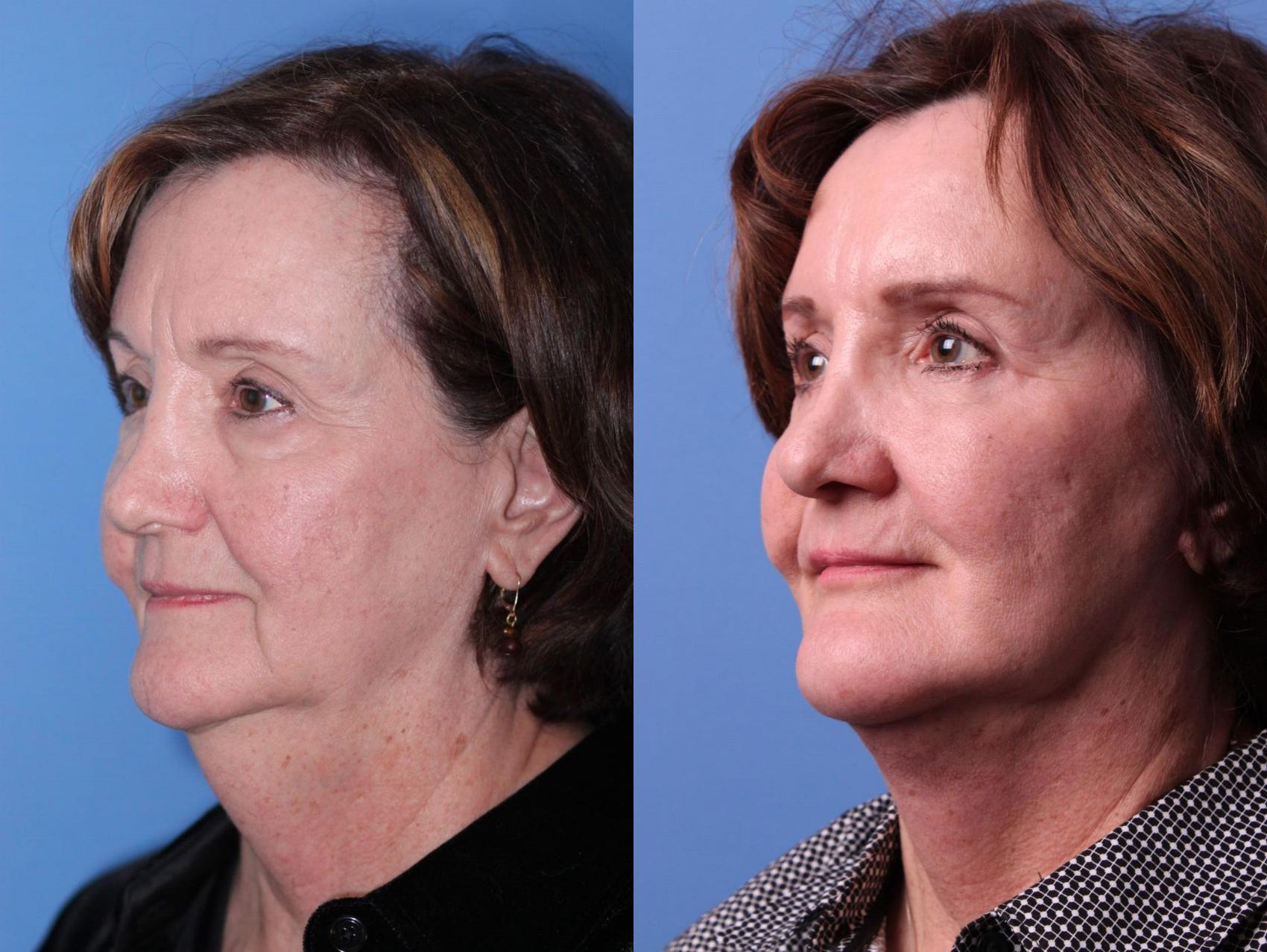 Before & After Facelift Case 74 View #2 View in Scottsdale, AZ