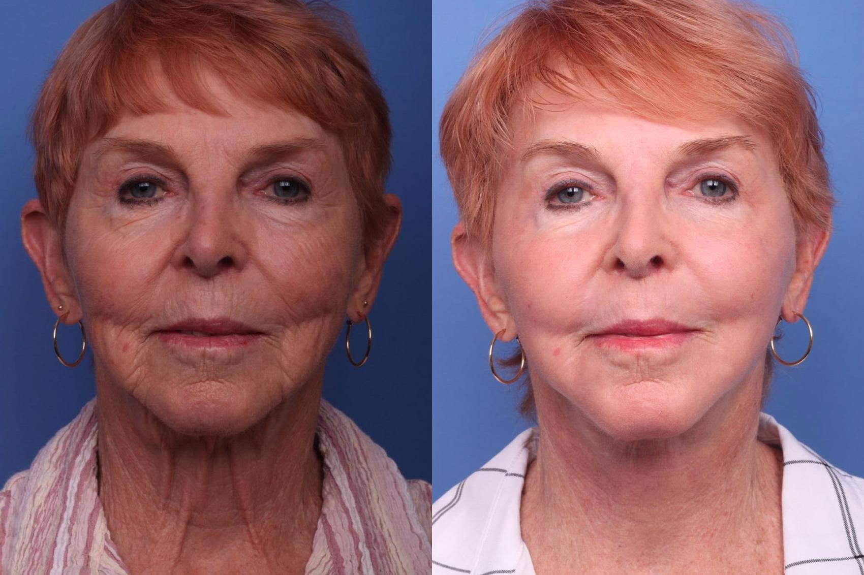 Before & After Facelift Case 75 View #1 View in Scottsdale, AZ