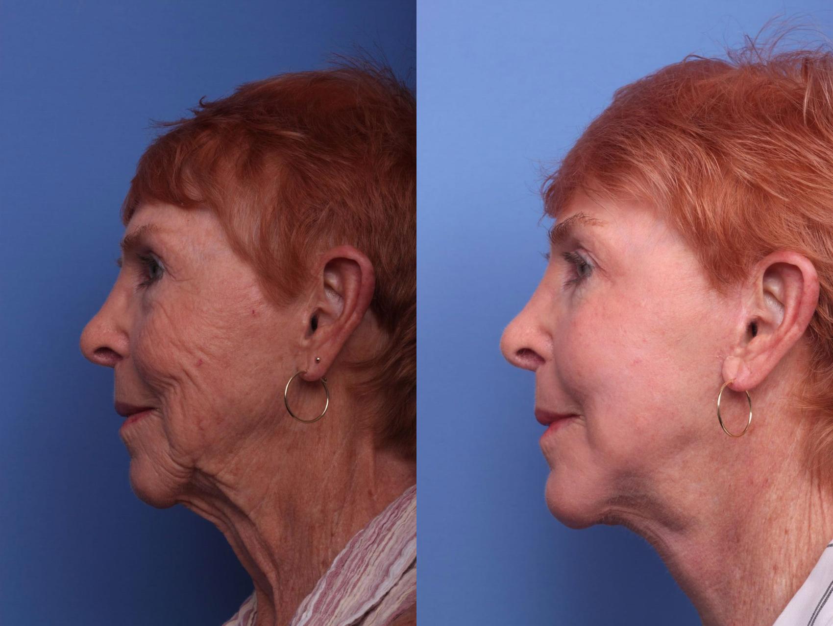 Facelift Before And After Pictures Case 75 Scottsdale Az Hobgood Facial Plastic Surgery