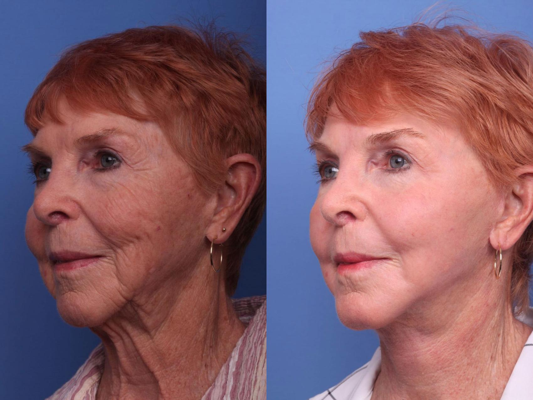 Before & After Facelift Case 75 View #3 View in Scottsdale, AZ