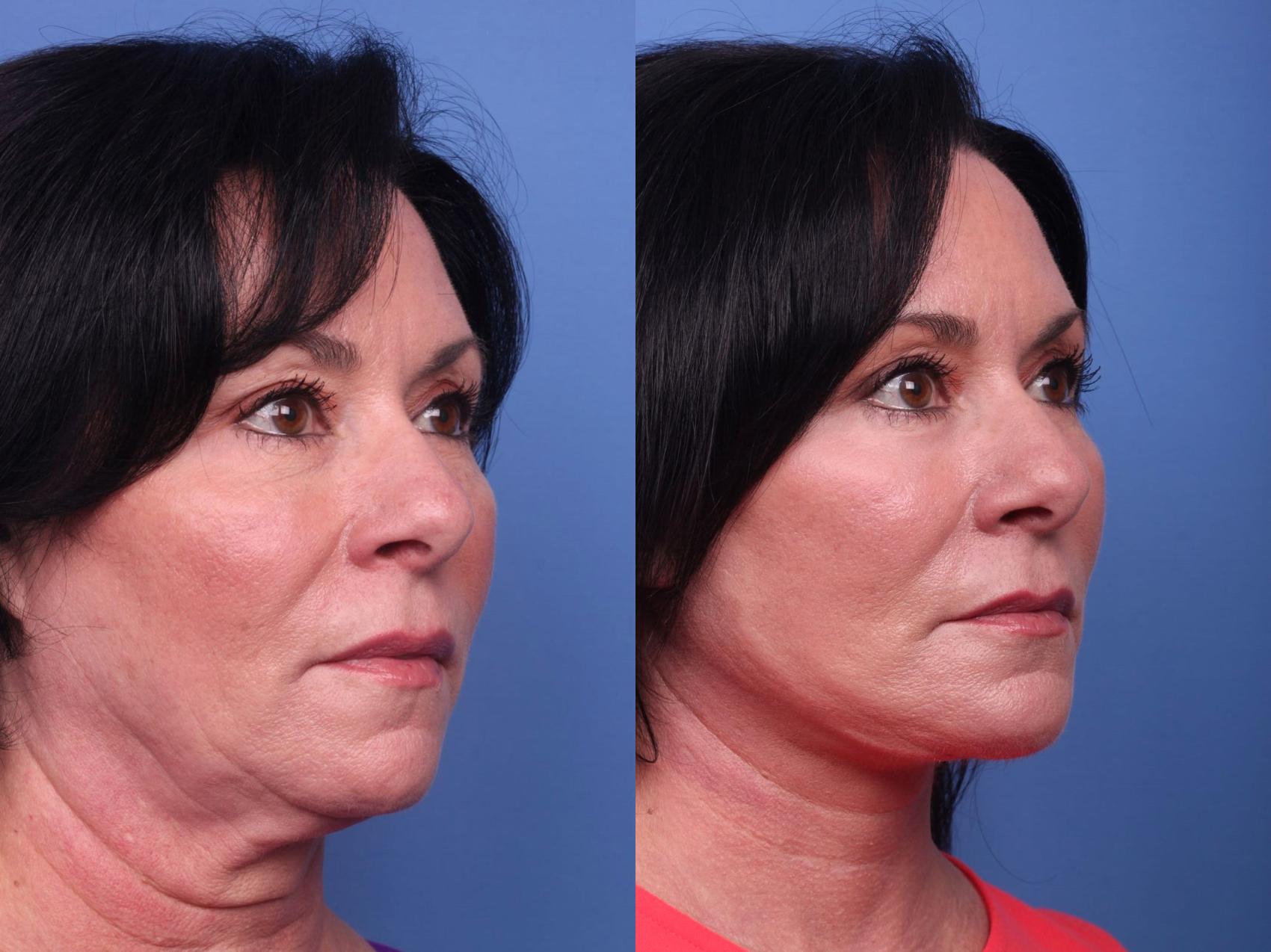 Before & After Facelift Case 77 View #2 View in Scottsdale, AZ
