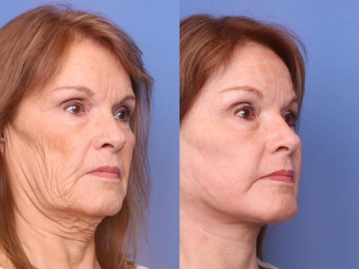 Facelift Before And After Pictures Case 83 Scottsdale Az Hobgood Facial Plastic Surgery
