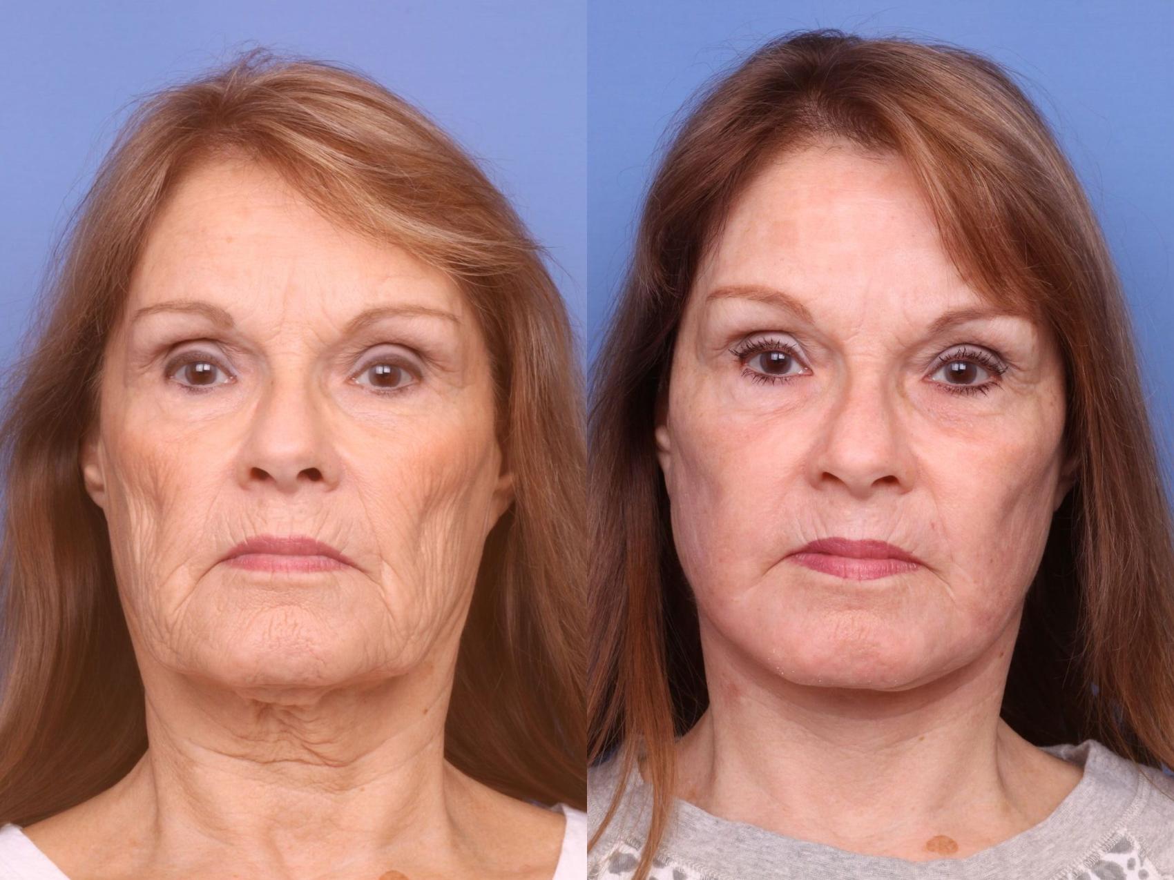 Before & After Facelift Case 83 View #2 View in Scottsdale, AZ