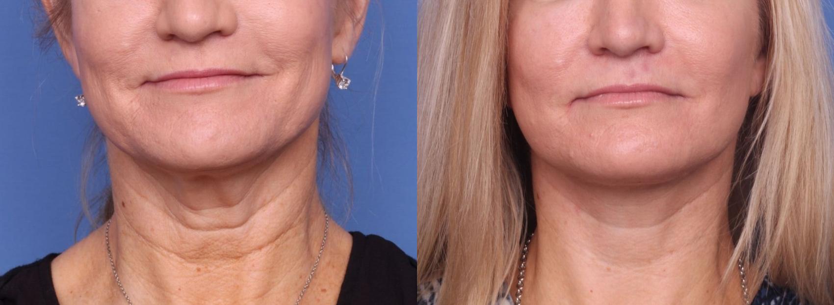 Before & After Facelift Case 84 View #1 View in Scottsdale, AZ