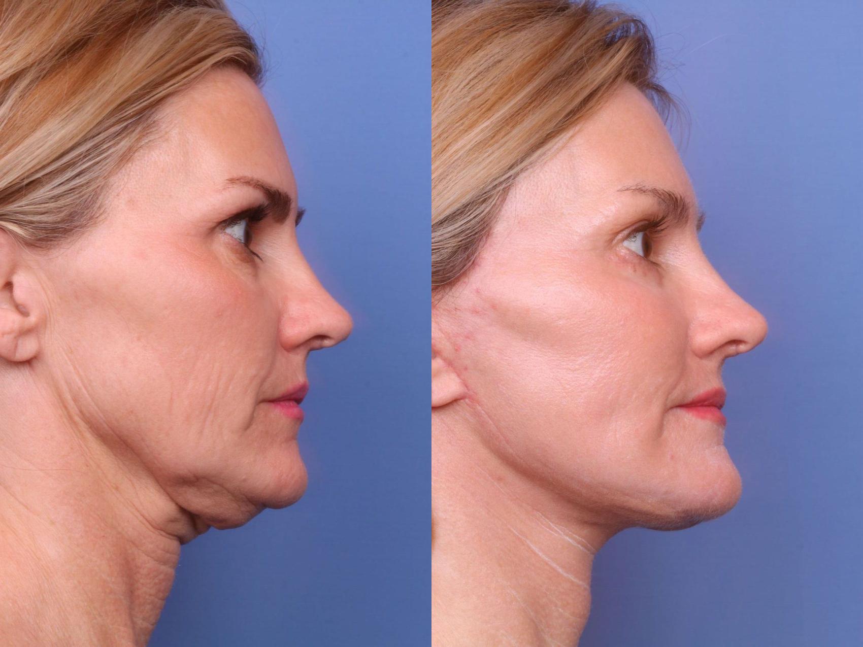 Before & After Facelift Case 85 View #2 View in Scottsdale, AZ