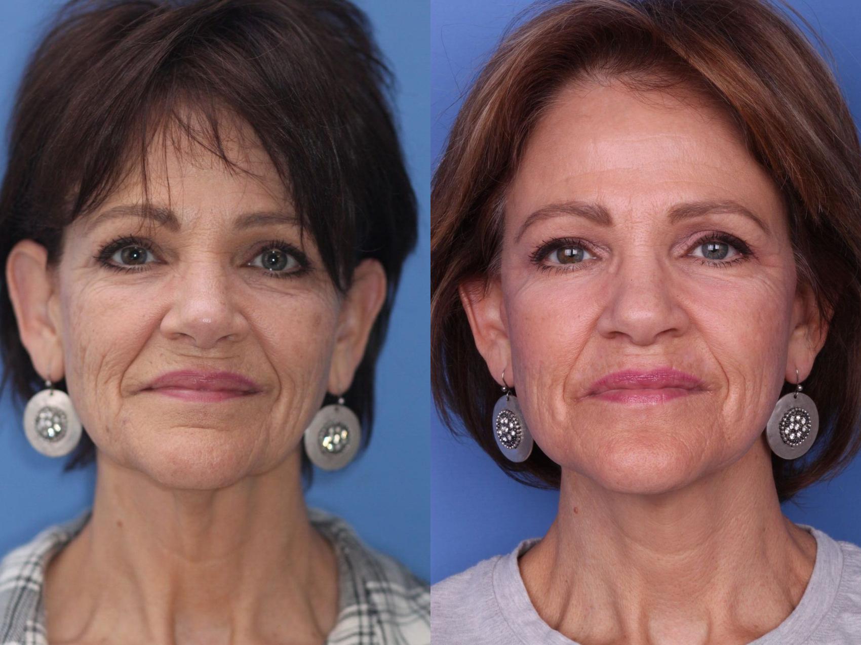 Before & After Facelift Case 86 View #2 View in Scottsdale, AZ