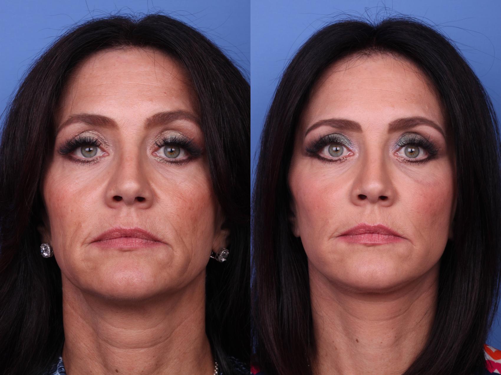 Before & After Facelift Case 87 View #2 View in Scottsdale, AZ