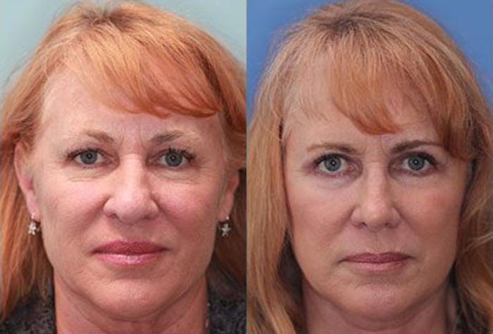Facelift Before & After Photo | Scottsdale, AZ | Hobgood Facial Plastic Surgery: Todd Hobgood, MD