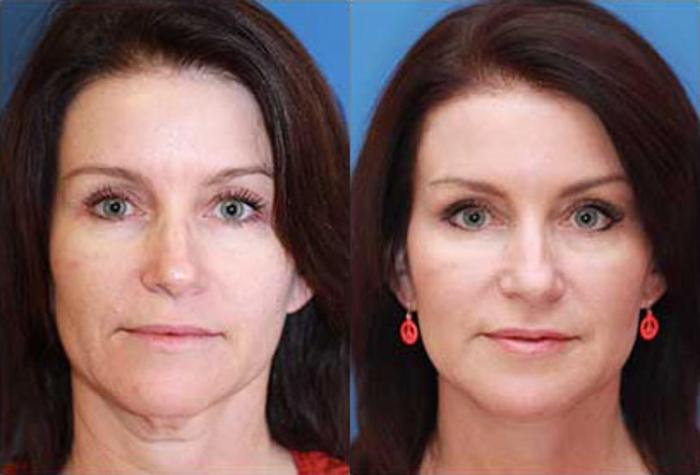 Facelift Before And After Pictures Case 89 Scottsdale Az Hobgood Facial Plastic Surgery