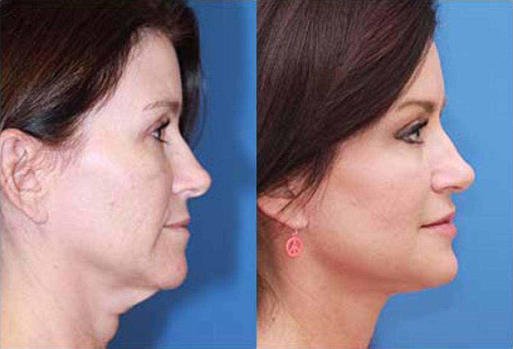 Facelift Before & After Photo | Scottsdale & Phoenix, AZ | Hobgood Facial Plastic Surgery: Todd Hobgood, MD