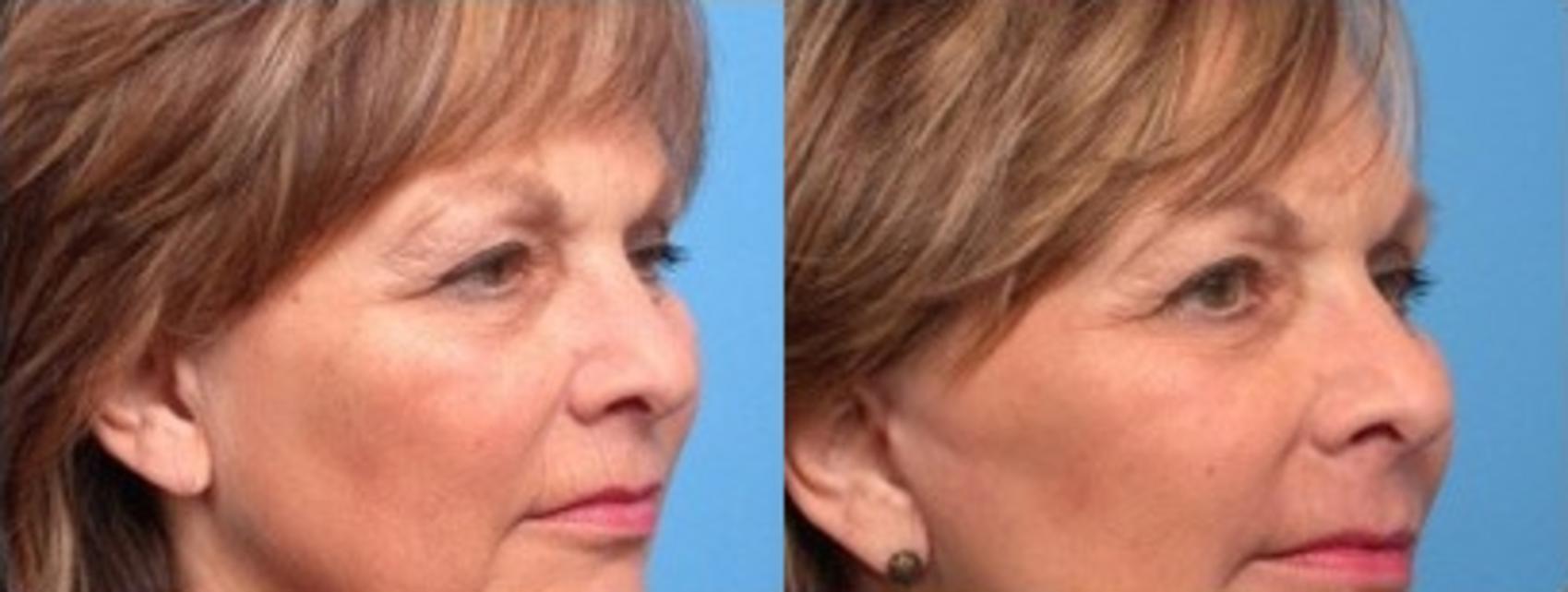 Before & After Facelift Case 93 View #2 View in Scottsdale, AZ