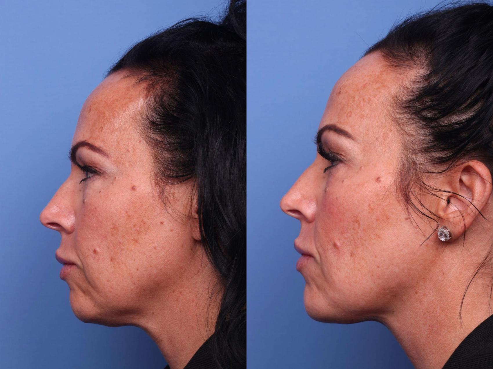 Facial Reconstruction Before & After Photo | Scottsdale, AZ | Hobgood Facial Plastic Surgery: Todd Hobgood, MD