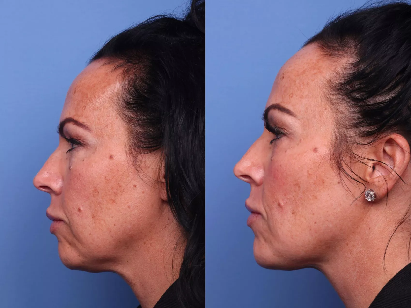 facial-reconstruction-121-view