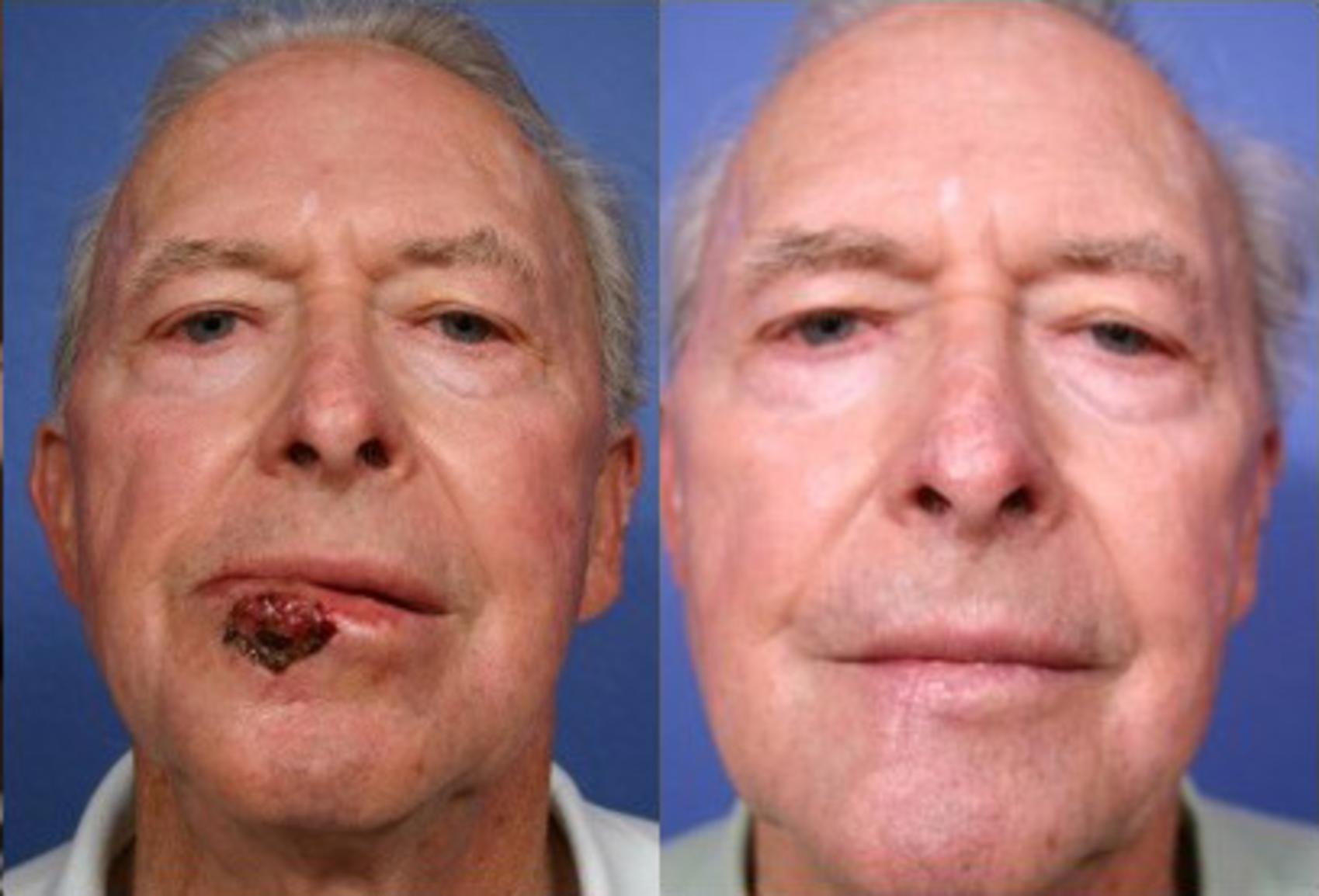Facial Reconstruction Before and After Pictures Case 122 Scottsdale
