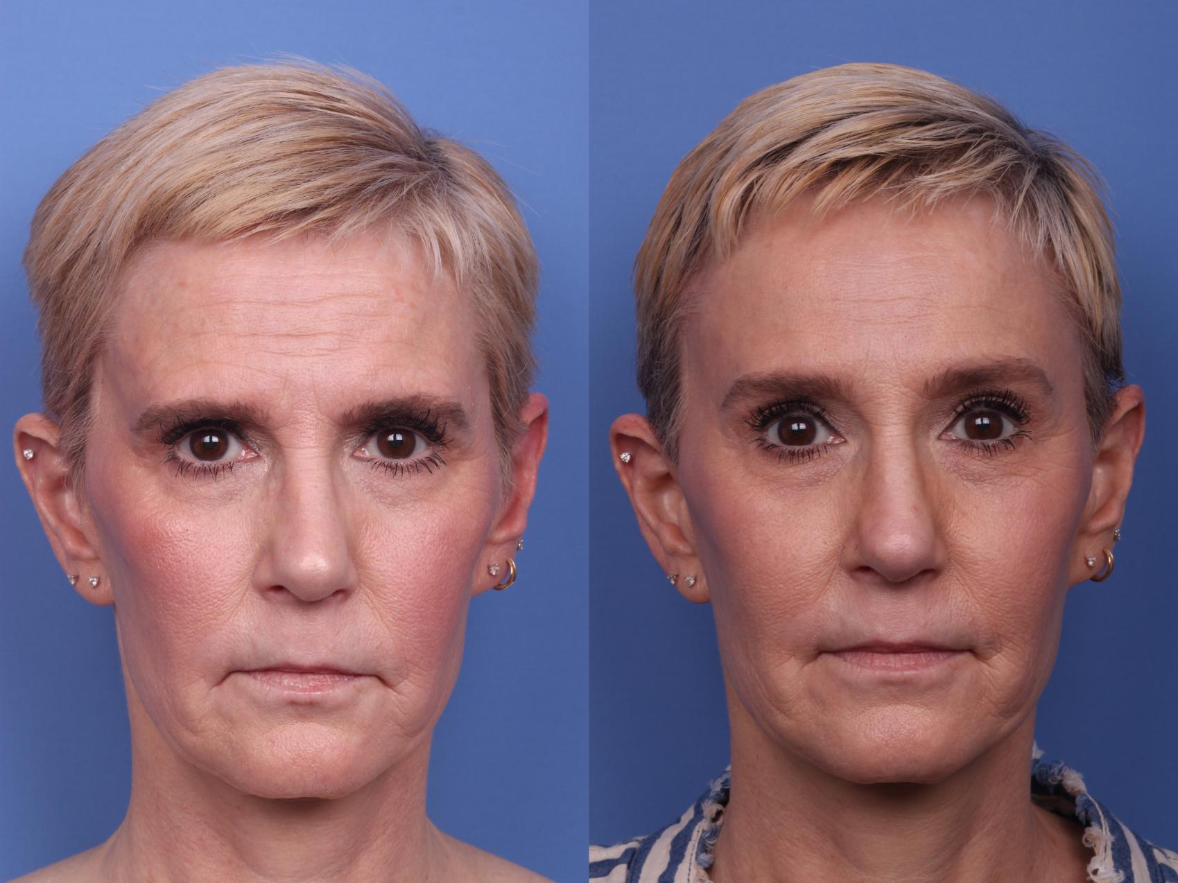 Facial Reconstruction Before & After Photo | Scottsdale, AZ | Hobgood Facial Plastic Surgery: Todd Hobgood, MD