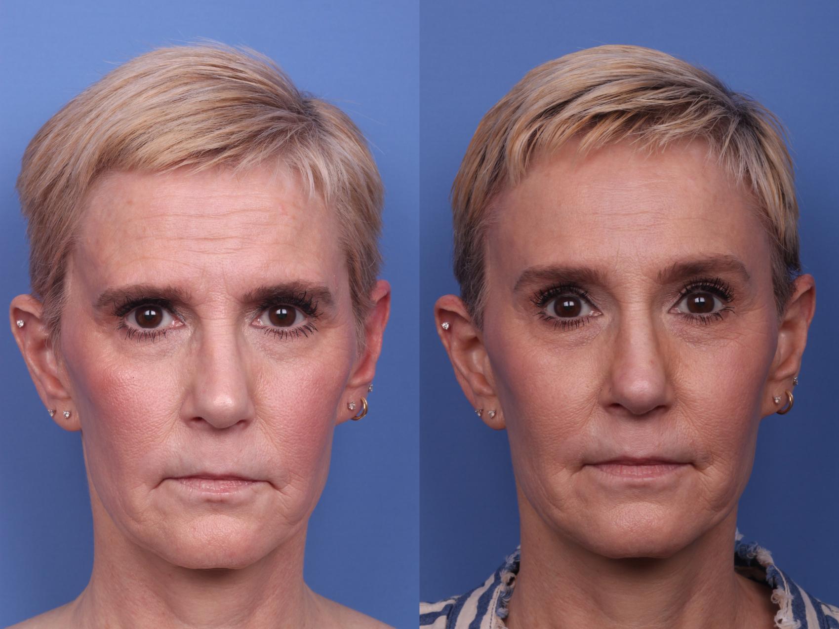 Facial Reconstruction Before & After Photo | Scottsdale & Phoenix, AZ | Hobgood Facial Plastic Surgery: Todd Hobgood, MD