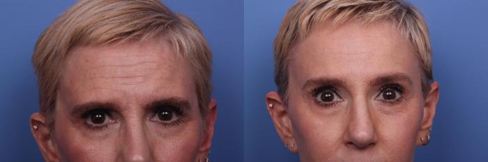 Facial Reconstruction Before & After Photo | Scottsdale & Phoenix, AZ | Hobgood Facial Plastic Surgery: Todd Hobgood, MD