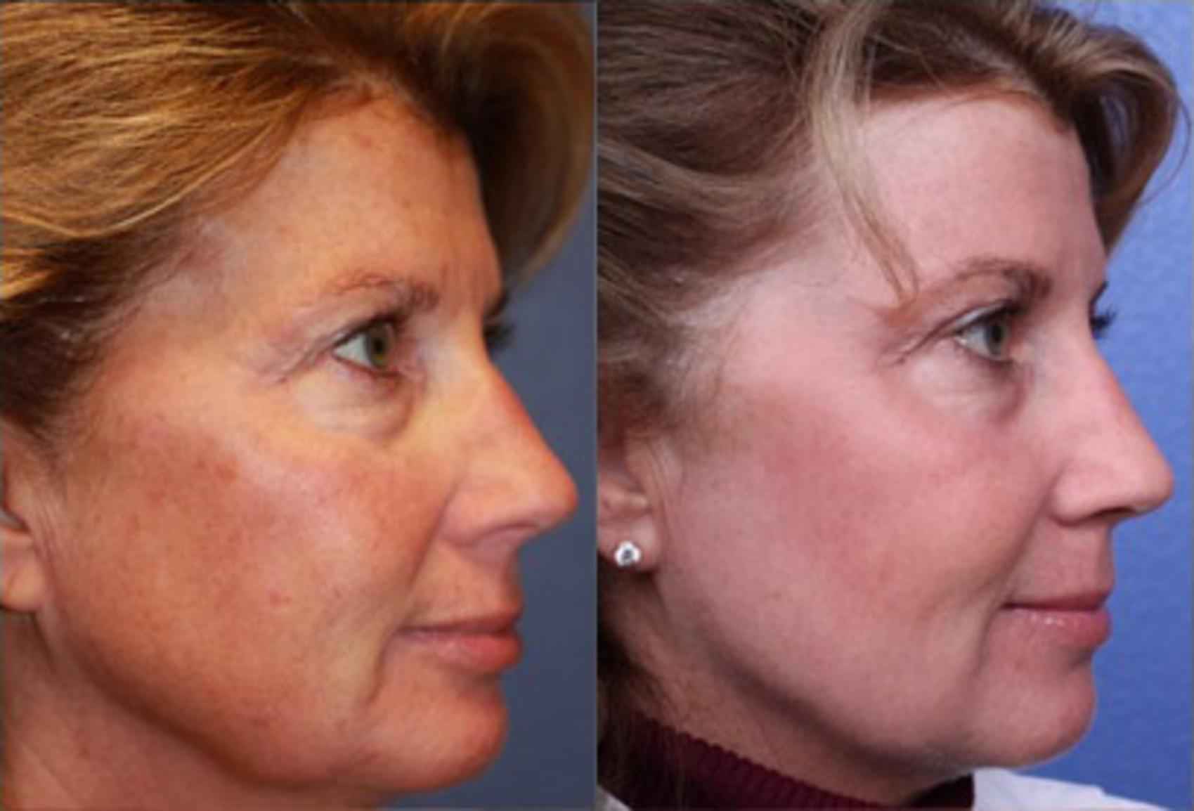 Fractionated CO2 Laser (no anesthesia) Before & After Photo | Scottsdale, AZ | Hobgood Facial Plastic Surgery: Todd Hobgood, MD