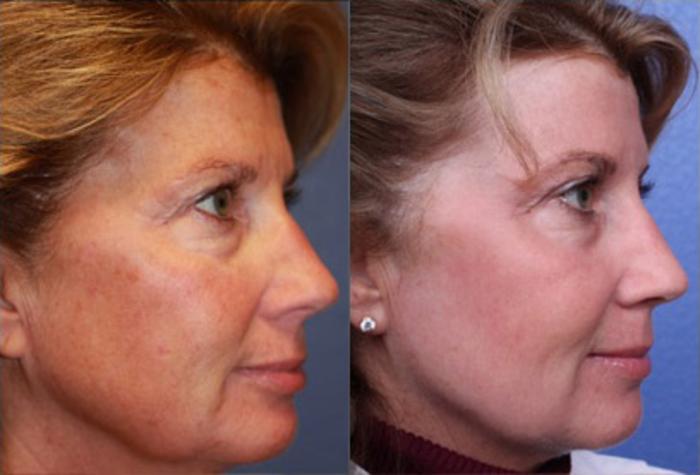 Fractionated CO2 Laser (no anesthesia) Before & After Photo | Scottsdale & Phoenix, AZ | Hobgood Facial Plastic Surgery: Todd Hobgood, MD
