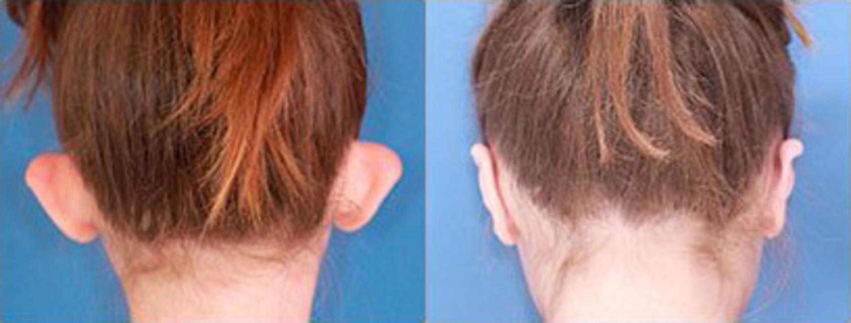 Before & After Otoplasty Case 113 View #2 View in Scottsdale, AZ
