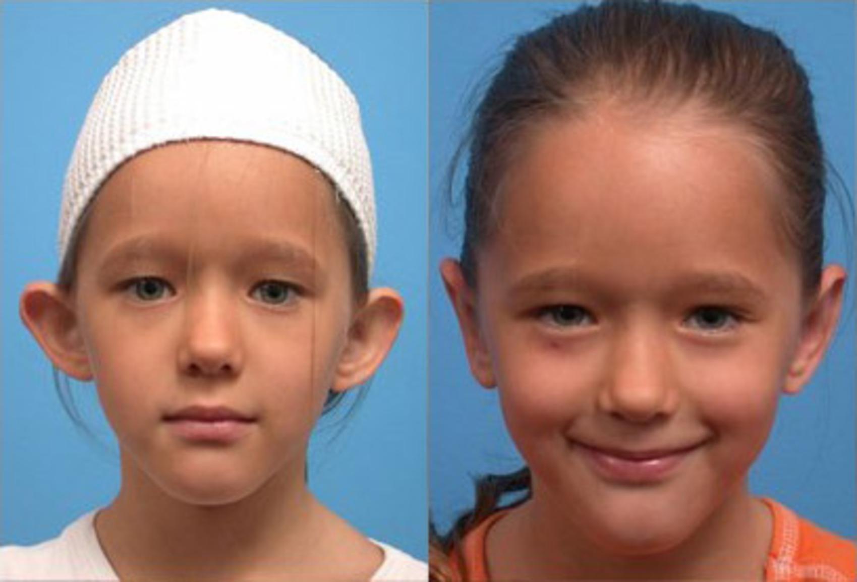 Otoplasty Before & After Photo | Scottsdale, AZ | Hobgood Facial Plastic Surgery: Todd Hobgood, MD
