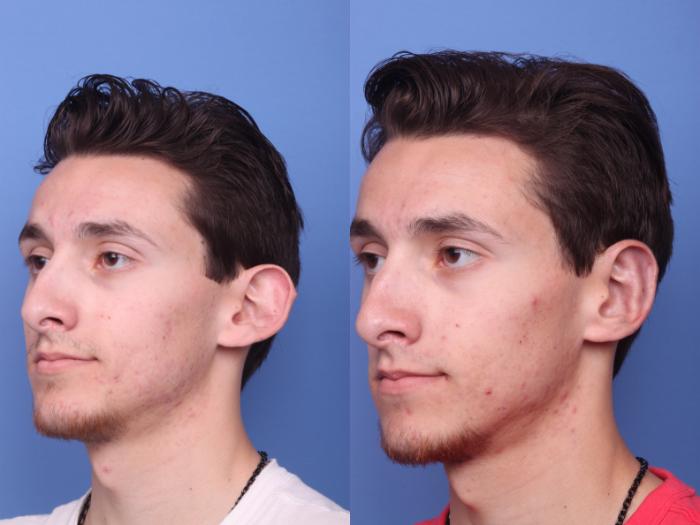 Otoplasty Before & After Photo | Scottsdale & Phoenix, AZ | Hobgood Facial Plastic Surgery: Todd Hobgood, MD
