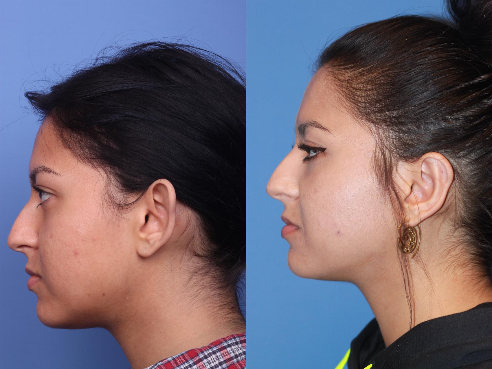 Before & After Otoplasty Case 162 View #2 View in Scottsdale, AZ