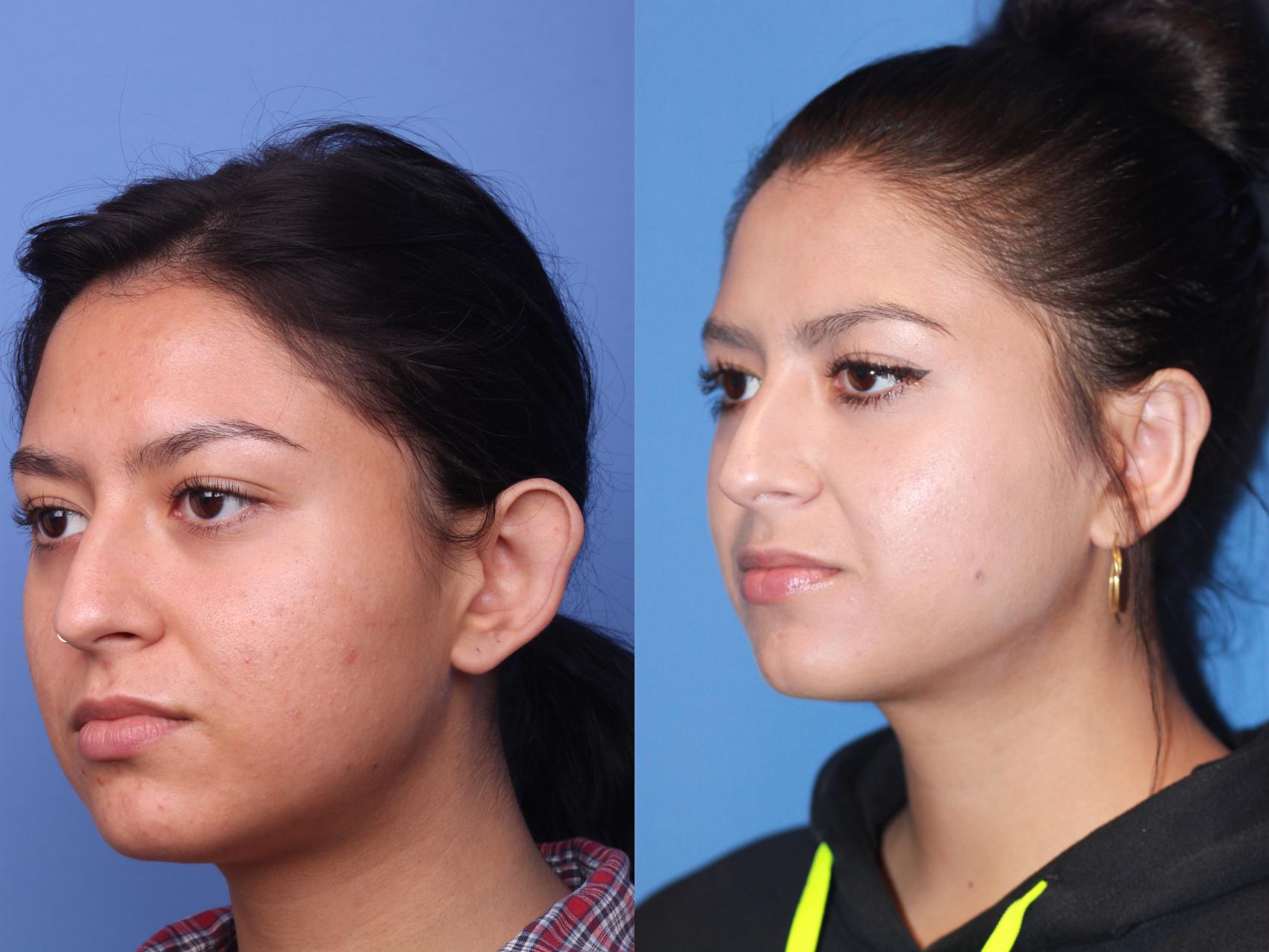 Before & After Otoplasty Case 162 View #3 View in Scottsdale, AZ