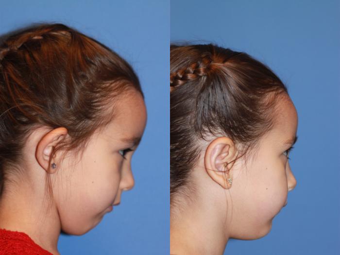 Otoplasty Before & After Photo | Scottsdale, AZ | Hobgood Facial Plastic Surgery: Todd Hobgood, MD