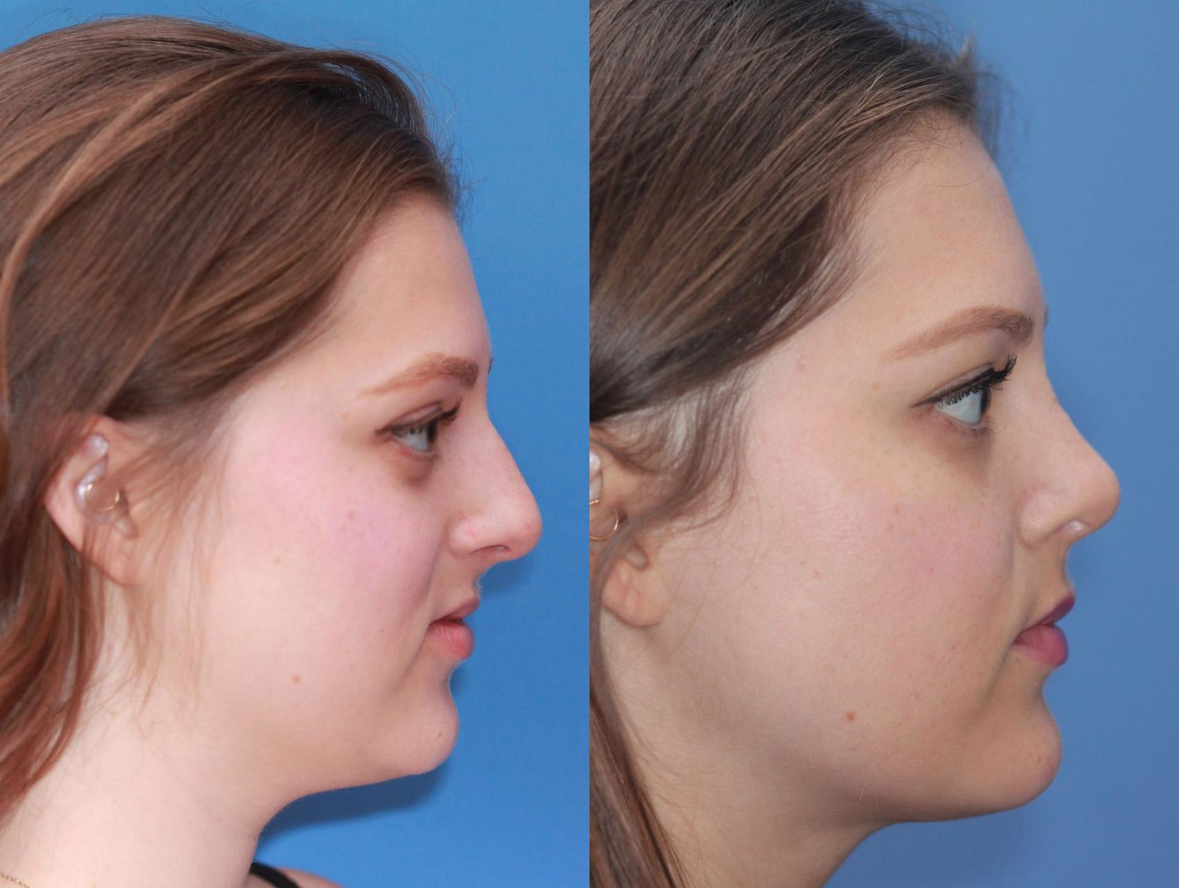 Before & After Rhinoplasty Case 10 View #2 View in Scottsdale, AZ