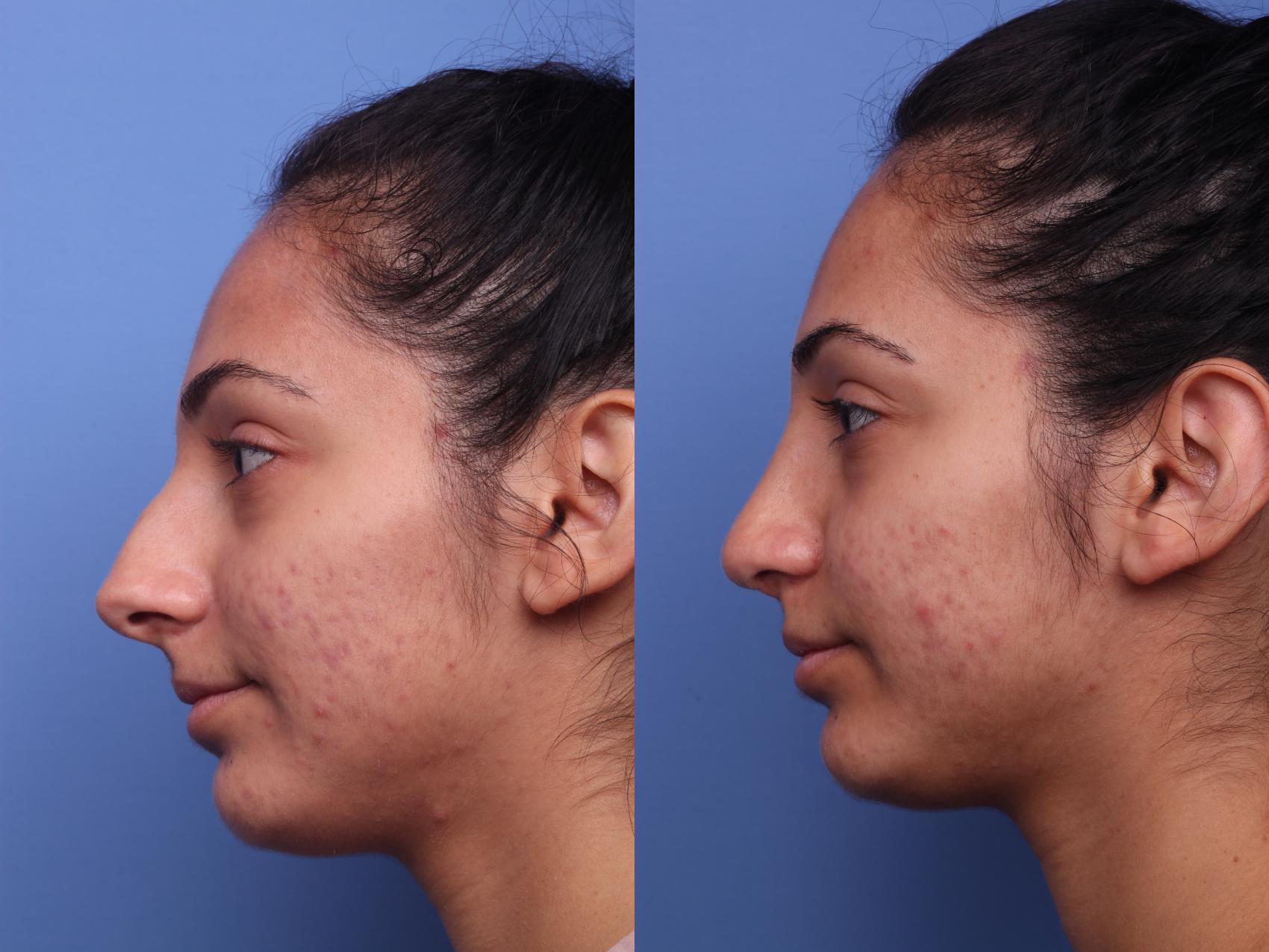 Before & After Rhinoplasty Case 128 View #2 View in Scottsdale, AZ