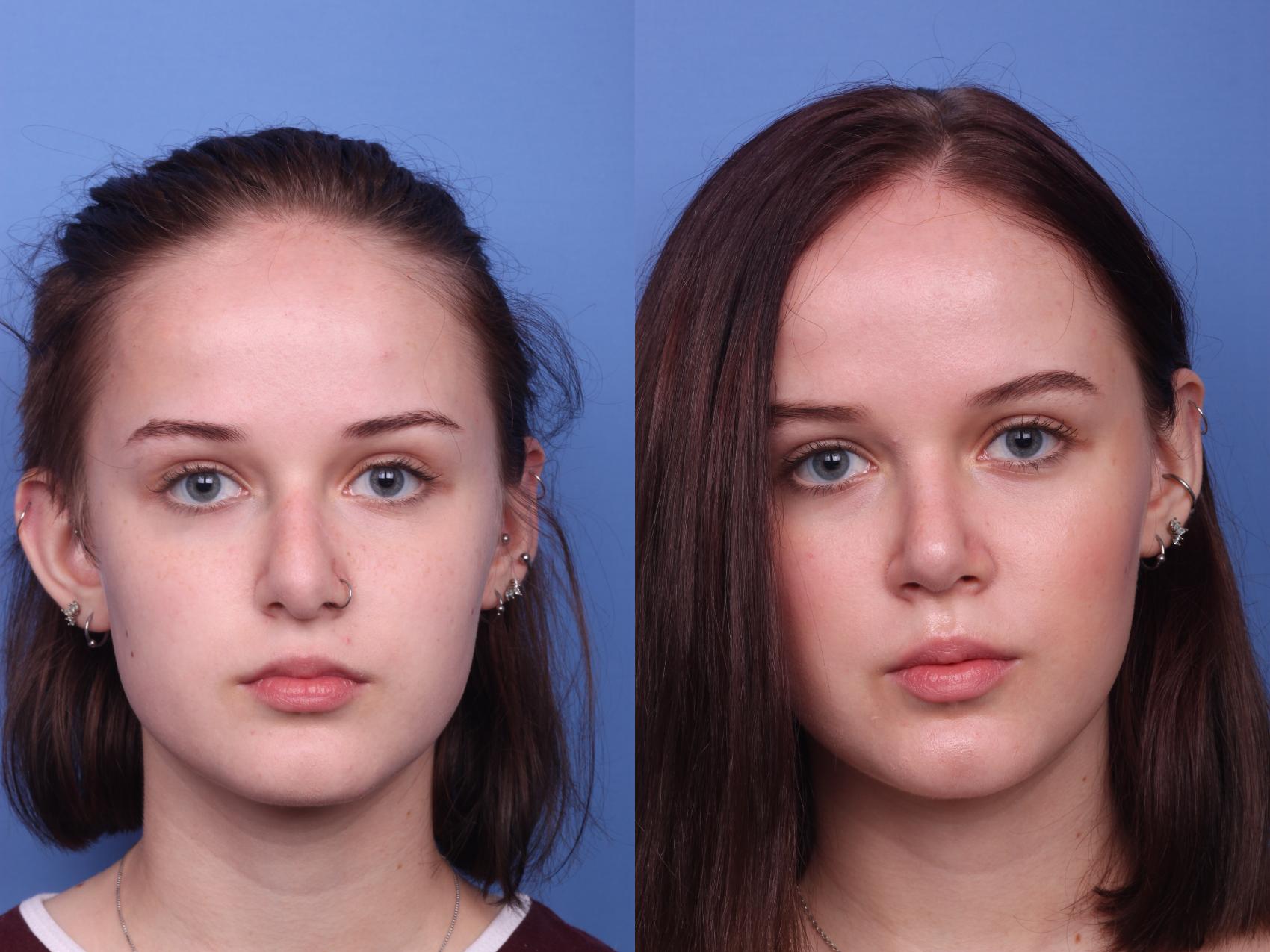 Before & After Rhinoplasty Case 129 View #2 View in Scottsdale, AZ