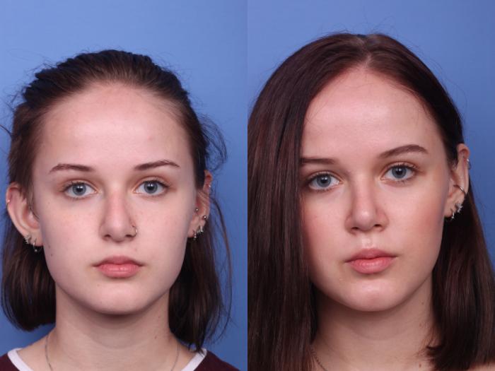Rhinoplasty Before & After Photo | Scottsdale, AZ | Hobgood Facial Plastic Surgery: Todd Hobgood, MD