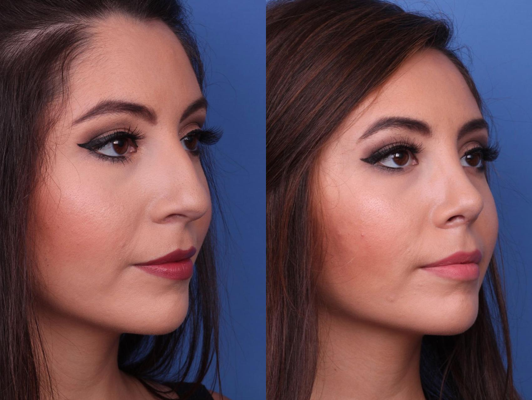 Before & After Rhinoplasty Case 13 View #2 View in Scottsdale, AZ