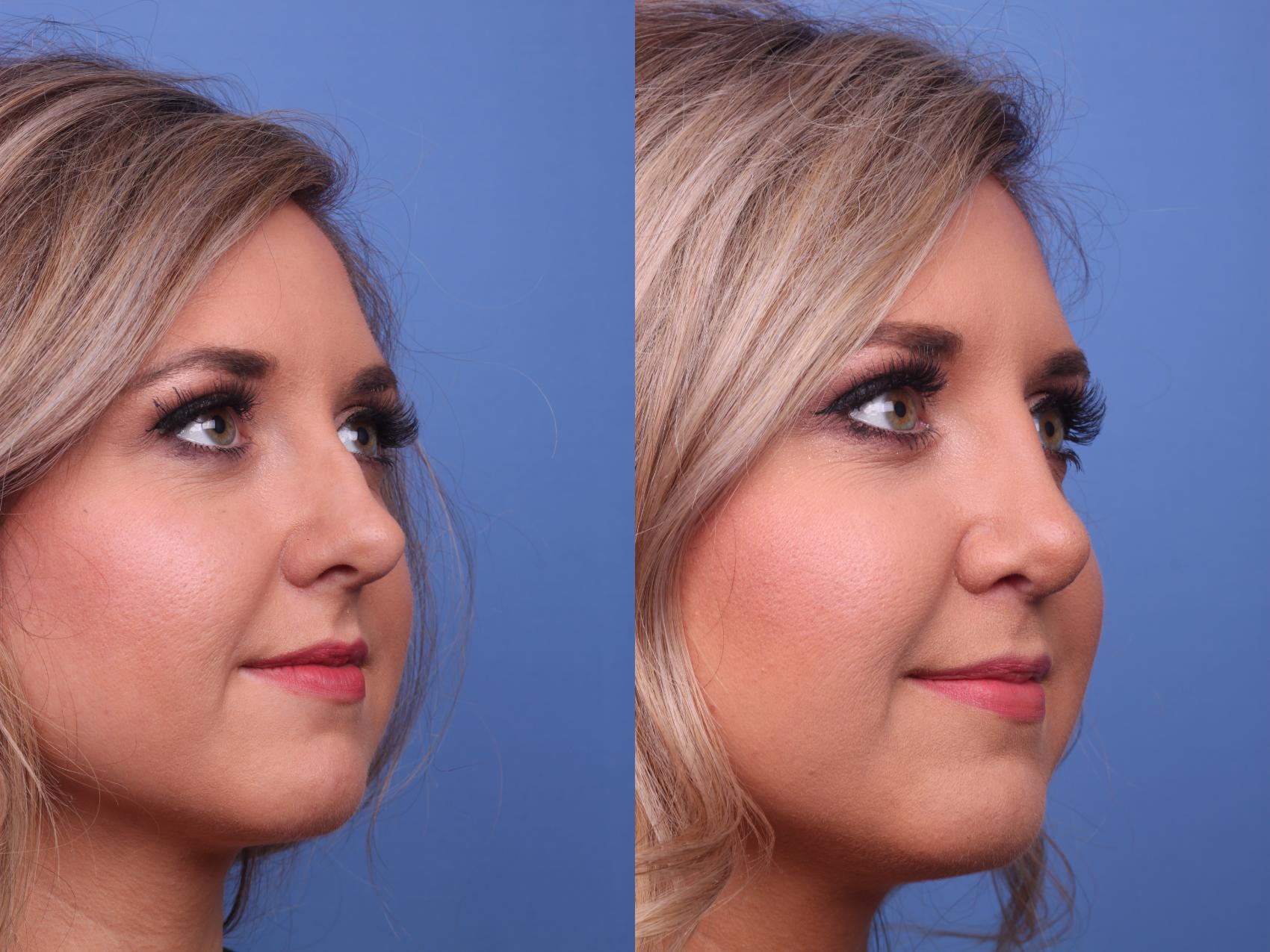 Before & After Rhinoplasty Case 131 View #2 View in Scottsdale, AZ