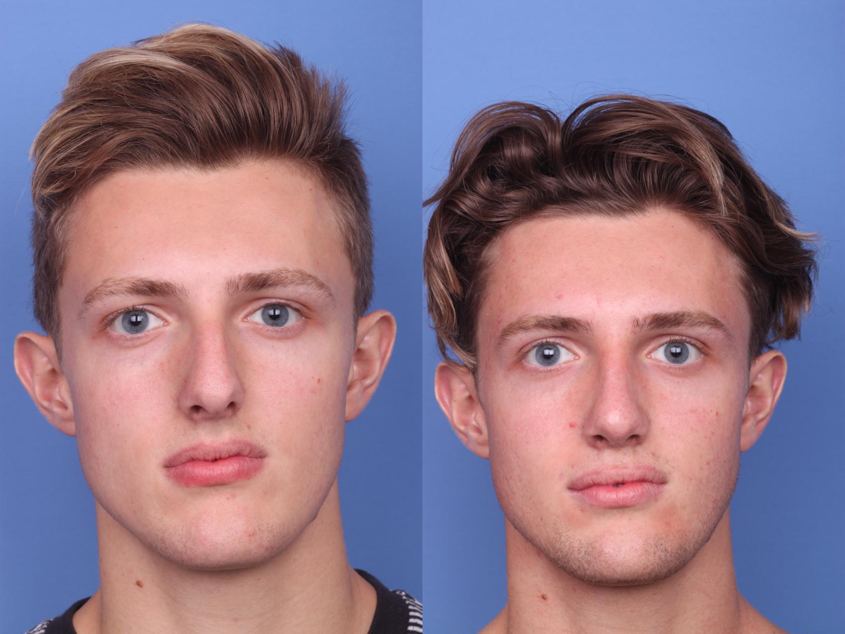 Before & After Rhinoplasty Case 132 View #2 View in Scottsdale, AZ