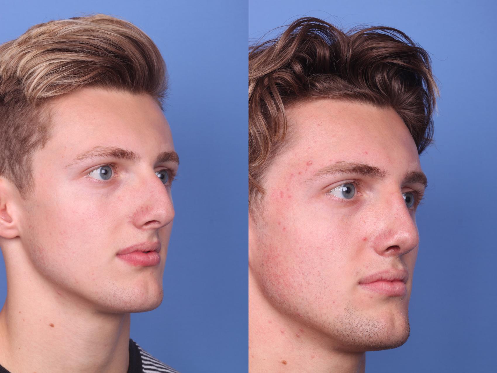 Before & After Rhinoplasty Case 132 View #3 View in Scottsdale, AZ