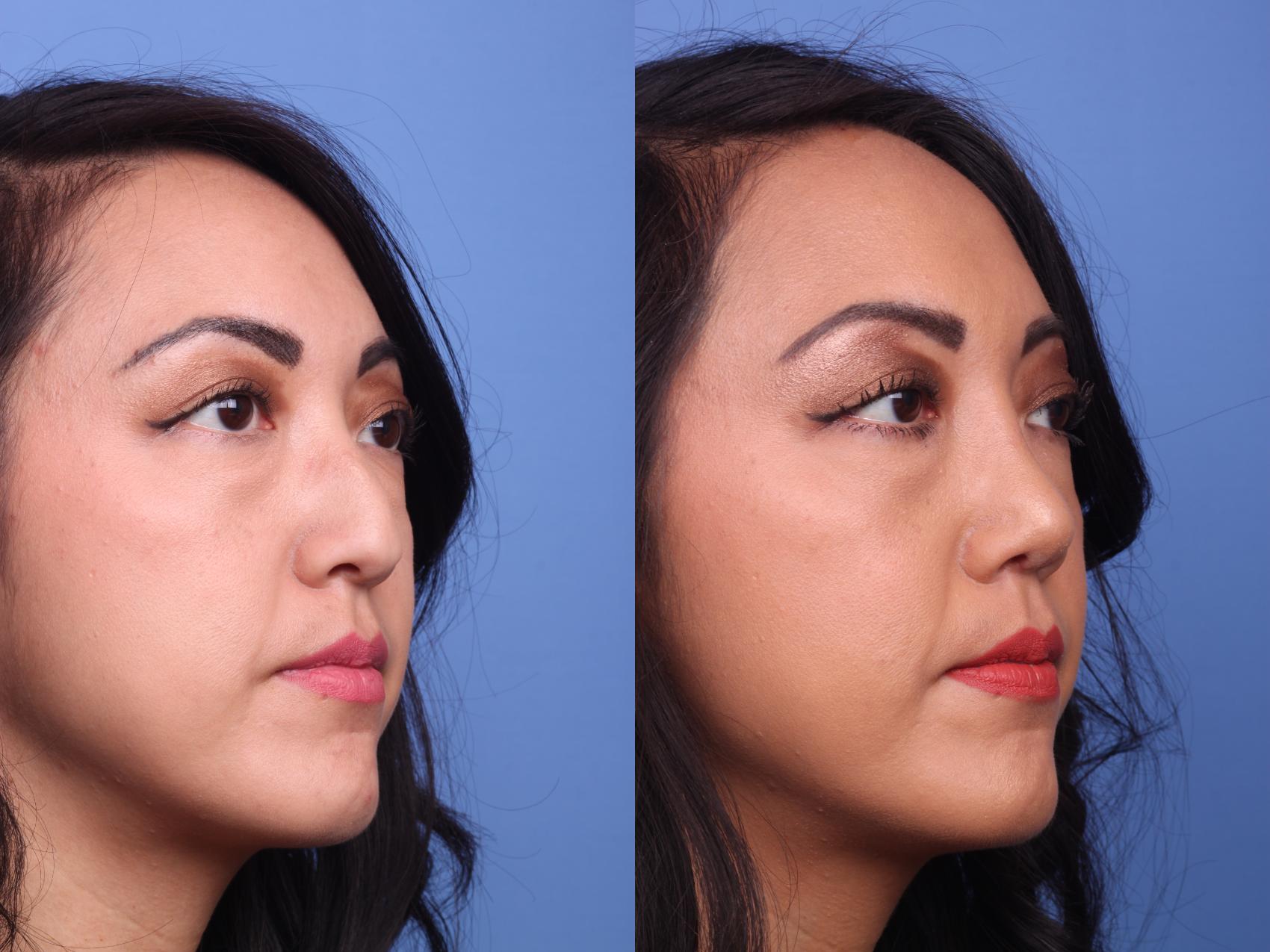 Before & After Rhinoplasty Case 134 View #2 View in Scottsdale, AZ