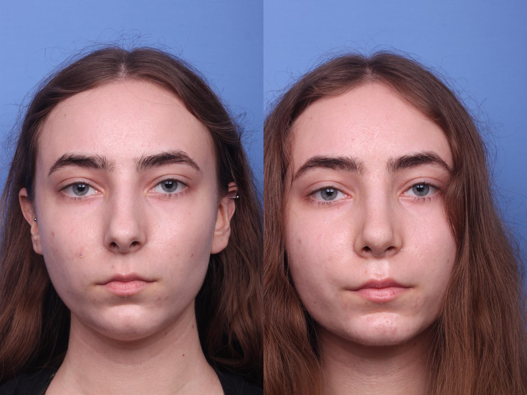 Before & After Rhinoplasty Case 135 View #2 View in Scottsdale, AZ